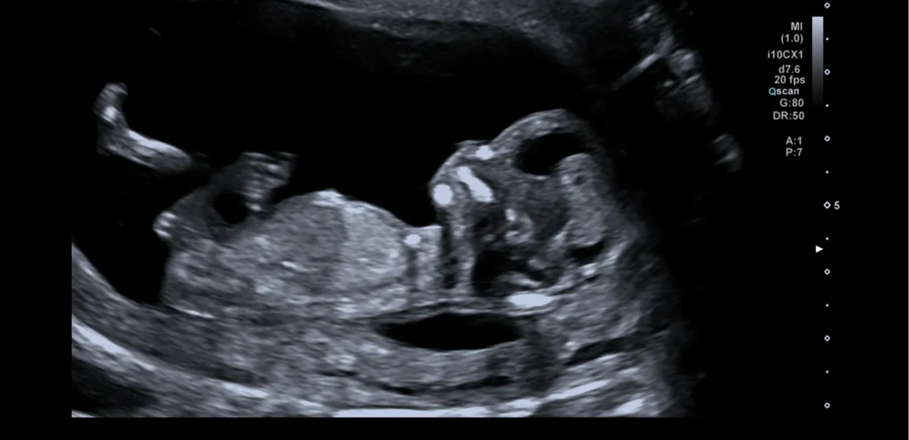 13 wekenecho: het profiel van de baby met hoofd, neus en buikje, in zijaanzicht