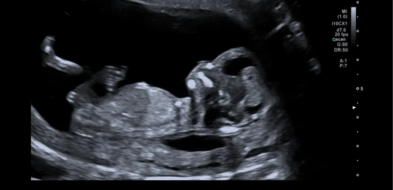 13 wekenecho: het profiel van de baby met hoofd, neus en buikje, in zijaanzicht