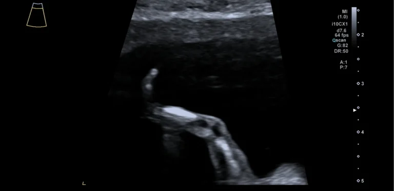 20 wekenecho: detailopname van een deel van het lichaam van de baby tijdens het structureel echoscopisch onderzoek