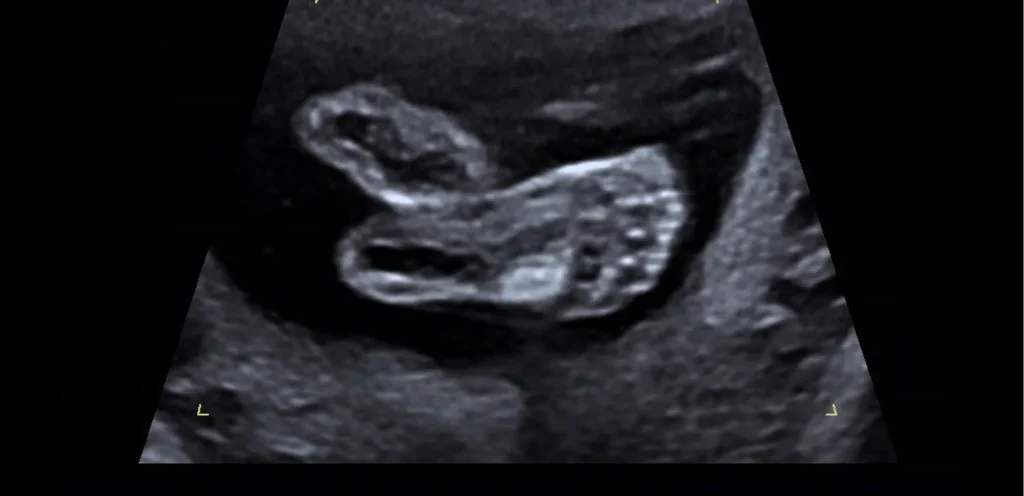 2D-echobeeld in zwart-wit van een baby in de baarmoeder