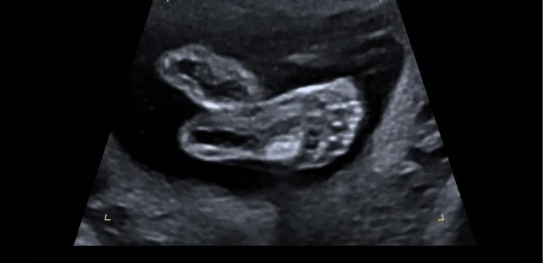 2D-echobeeld in zwart-wit van een baby in de baarmoeder