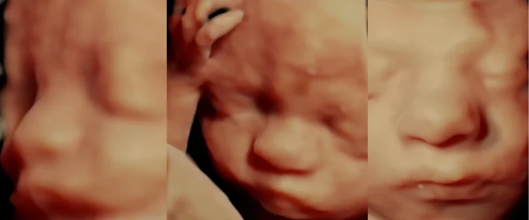 Drie 3D-echobeelden naast elkaar van het gezichtje van een baby, met neus, mond en een handje bij het hoofd