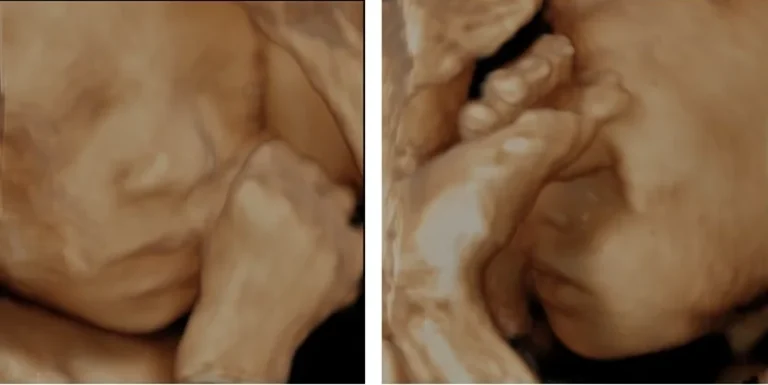 Twee 3D-echobeelden: links het gezichtje van de baby met een handje, rechts een close-up van handje en gezicht