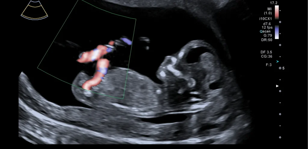 Echo bij bloedverlies: de baby in zijaanzicht, met de bloedstroom in de navelstreng rood en blauw gekleurd door kleurendoppler