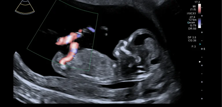 Echo bij bloedverlies: de baby in zijaanzicht, met de bloedstroom in de navelstreng rood en blauw gekleurd door kleurendoppler