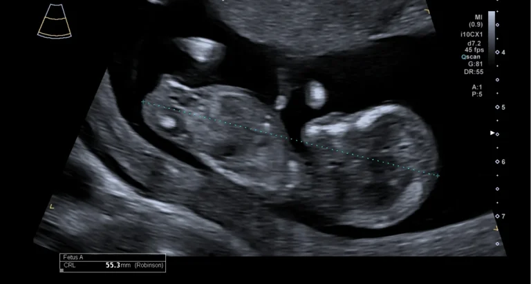 Echobeeld waarop de kruin-stuitlengte van de baby wordt gemeten, met de meetwaarde 55,3 mm in beeld
