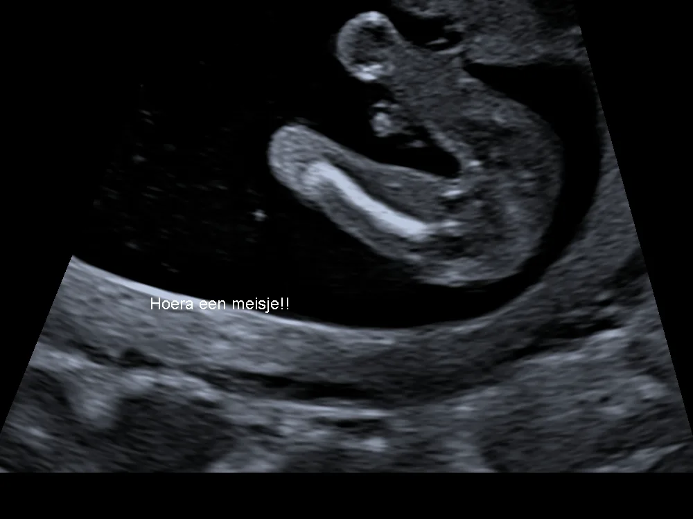 2D-echo van een geslachtsbepaling: de baby in zijaanzicht, met de tekst ‘Hoera een meisje!!’ in beeld