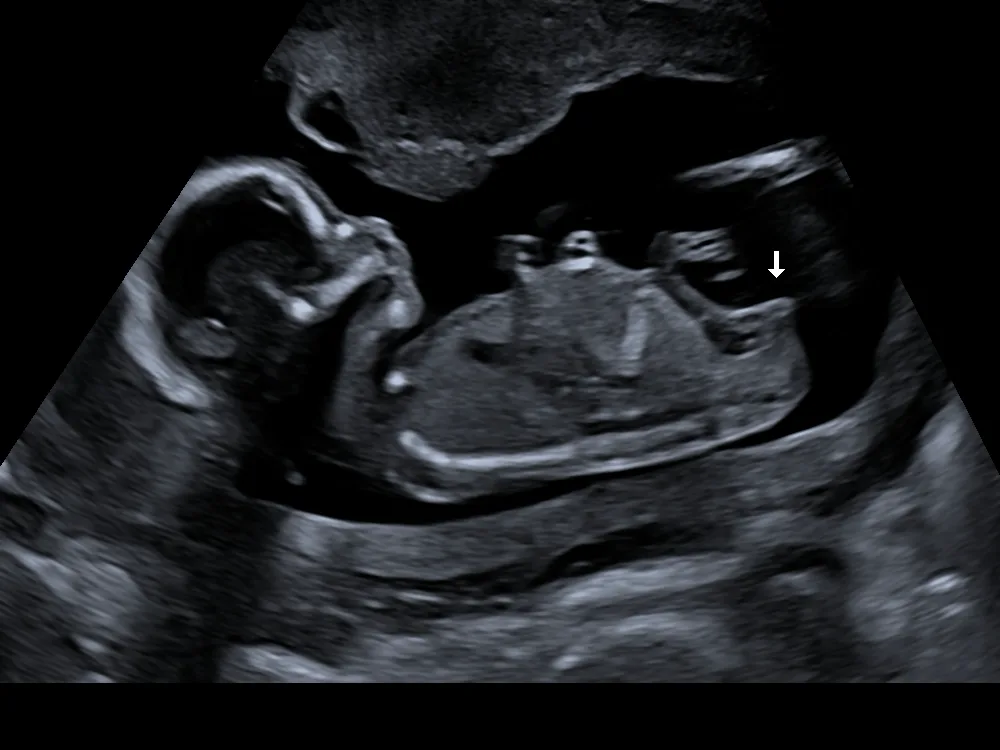 2D-echobeeld bij een geslachtsbepaling, waarin een witte pijl het geslacht van de baby aanwijst
