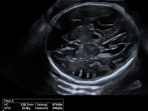 Groeiecho waarop de hoofdomtrek van de baby wordt gemeten met een ovaal rond het hoofdje, met de meetwaarde 328,5 mm