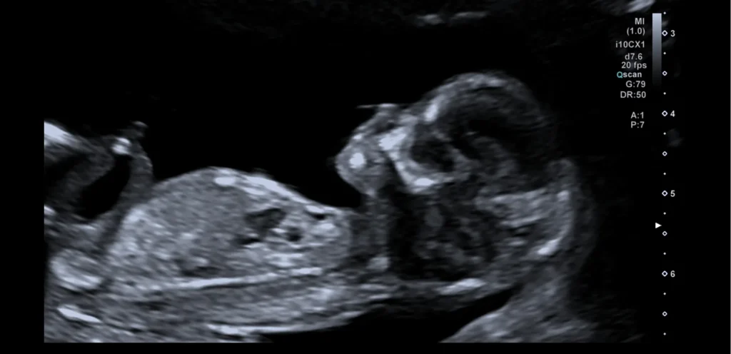 Echobeeld van de baby in zijaanzicht, gemaakt om de ligging van de placenta ten opzichte van de baarmoedermond te bepalen