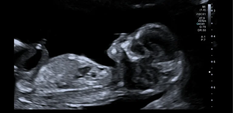 Echobeeld van de baby in zijaanzicht, gemaakt om de ligging van de placenta ten opzichte van de baarmoedermond te bepalen