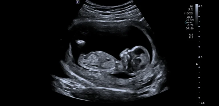 Termijnecho: de baby ligt in zijaanzicht in de vruchtzak, hoofd en lichaampje zijn duidelijk te zien