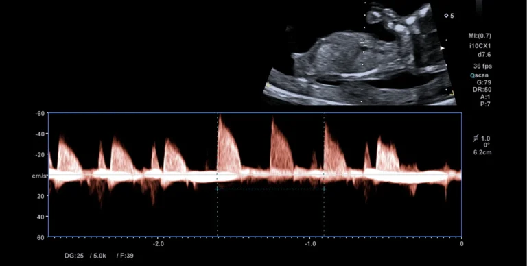 Vitaliteitsecho met dopplermeting: de hartslag van de baby is als golflijn zichtbaar onder het echobeeld